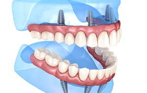 Illustration of All-on-4 implants for upper and lower arches