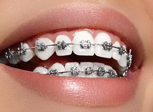 Close-up of woman’s smile with traditional metal braces