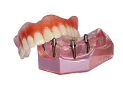 Implant denture balanced on gum model against white background