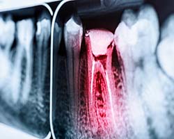 X-ray diagram of a toothache in Enfield