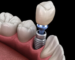 Illustration of implant, abutment, and crown being placed in mouth
