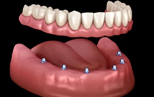 implant-retained overdenture