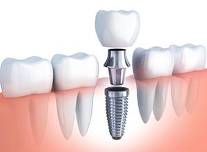 Diagram of dental implants in Enfield