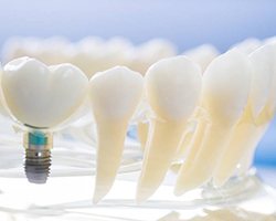 Model of dental implants in Enfield