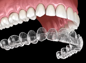 Illustration of clear aligner being placed on upper teeth