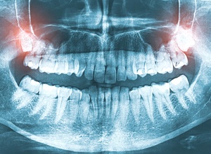 wisdom teeth x-ray