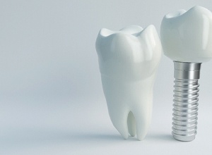 dental implant and tooth