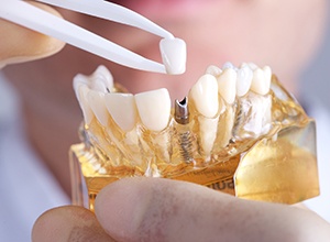 Model of implant supported dental crown