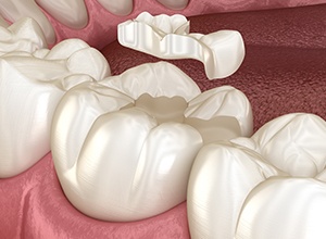 graphic of tooth-colored filling