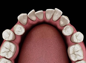 Illustration of crooked teeth in bottom dental arch