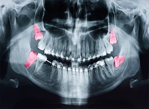 Wisdom teeth X-Ray