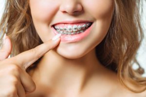 Woman with braces pointing at her teeth