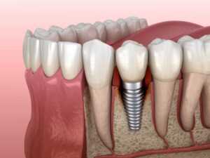 Illustration showing infected tissue around a dental implant
