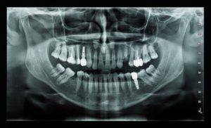 X-ray showing dental implants