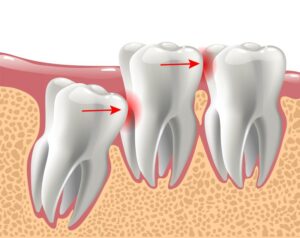 Illustration showing impacted wisdom tooth 