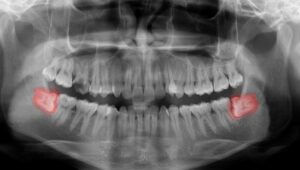 Dental X-ray showing sideways wisdom teeth in the lower arch